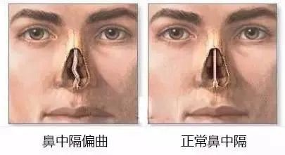 鼻中隔偏曲还能引起鼻出血，耳鼻喉专家分析鼻中隔常见的症状_医学界-助力医生临床决策和职业成长